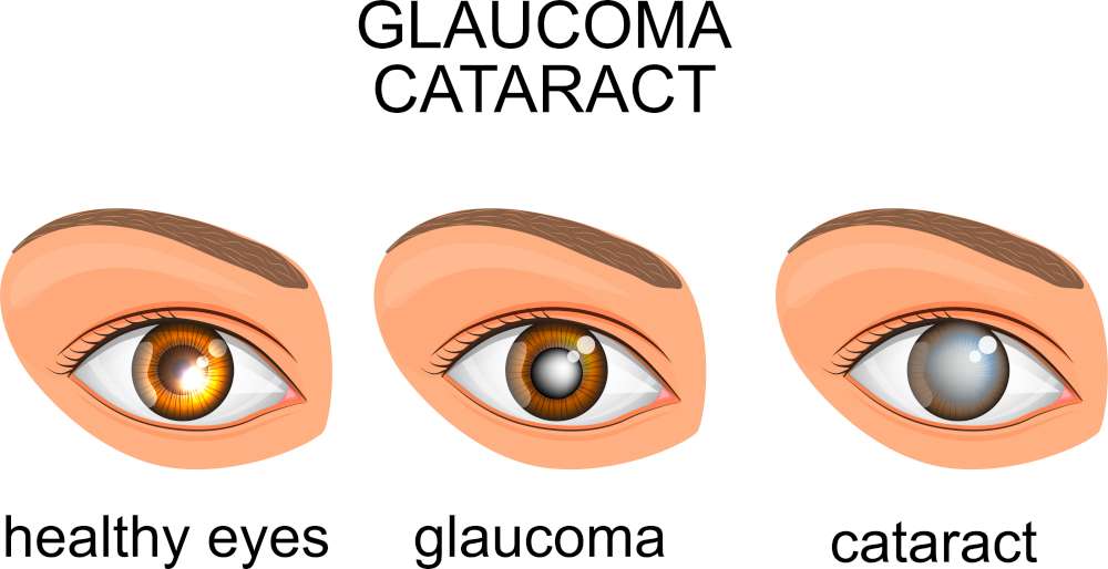 glaucoma eye vs normal eye