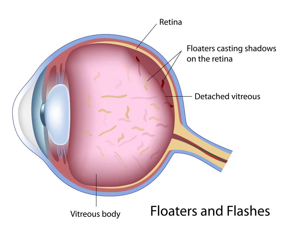 Cataracts, Glaucoma and Detached Retinas … Facing the Challenges of Aging Eyes